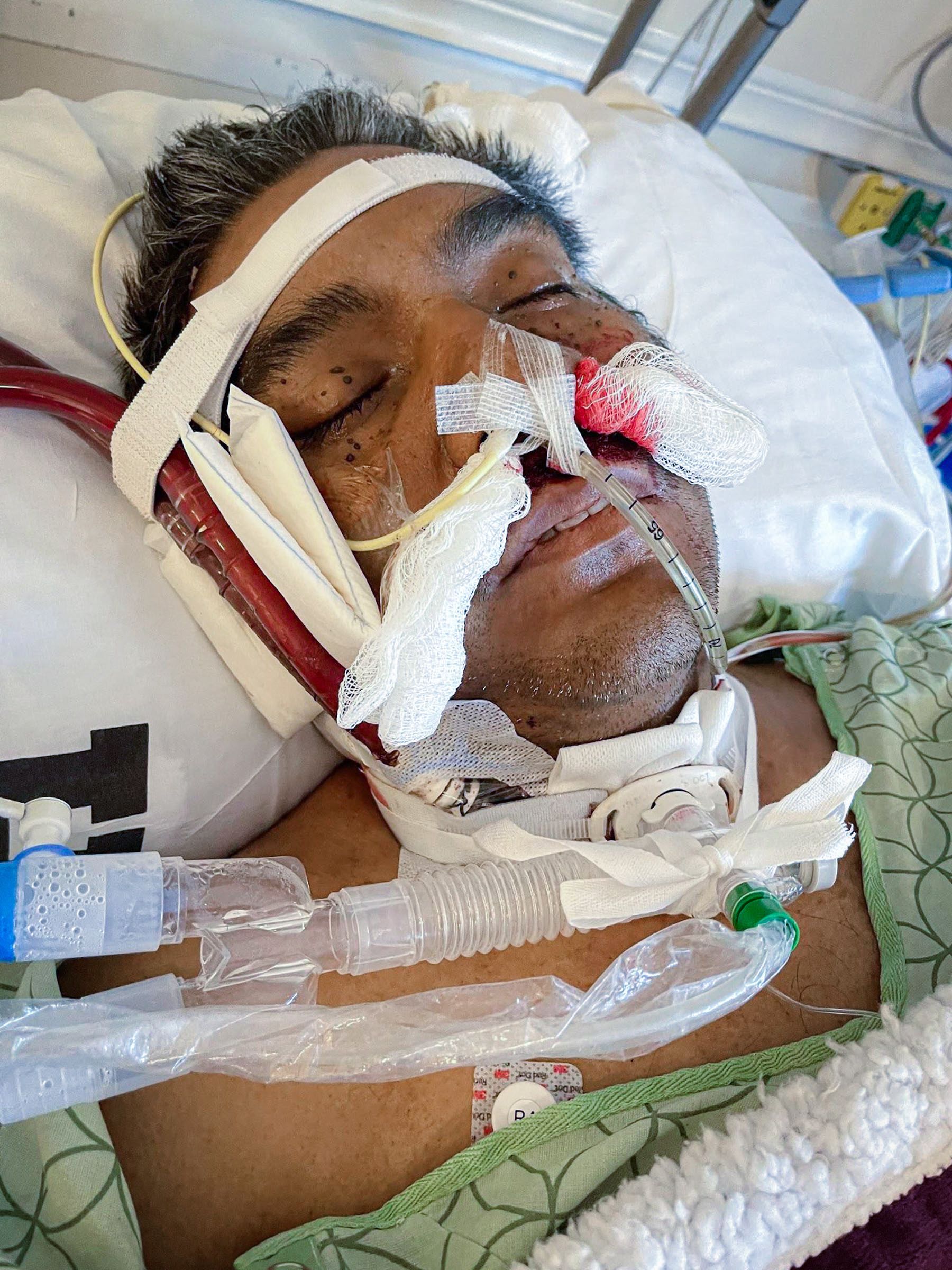 Close up of Manny asleep with blood-soaked cotton in his nose.