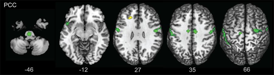 fMRI imagery showing the effects of childhood adversity on the brain